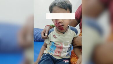 Four-year-old attacked by stray dog while playing in Telangana's Nalgonda
