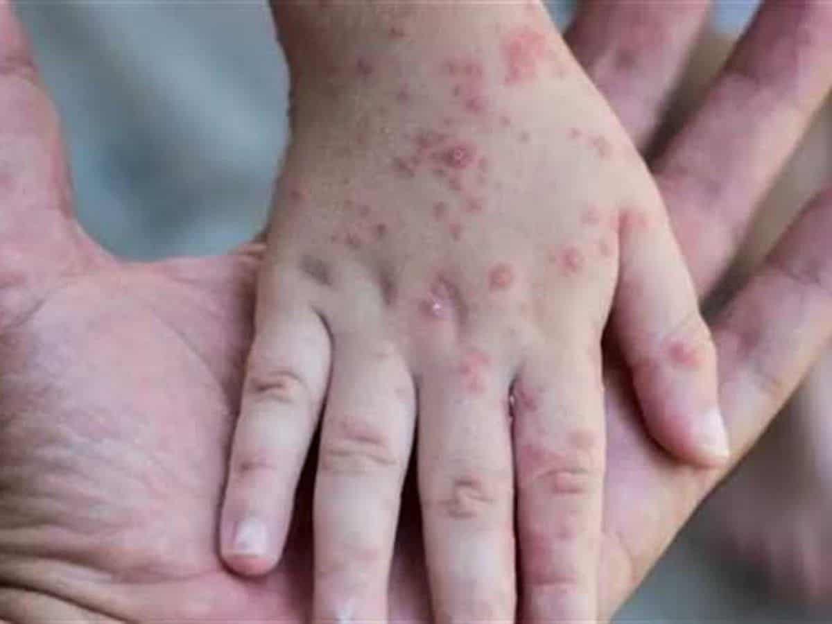 China tightens measures to prevent import of monkeypox virus