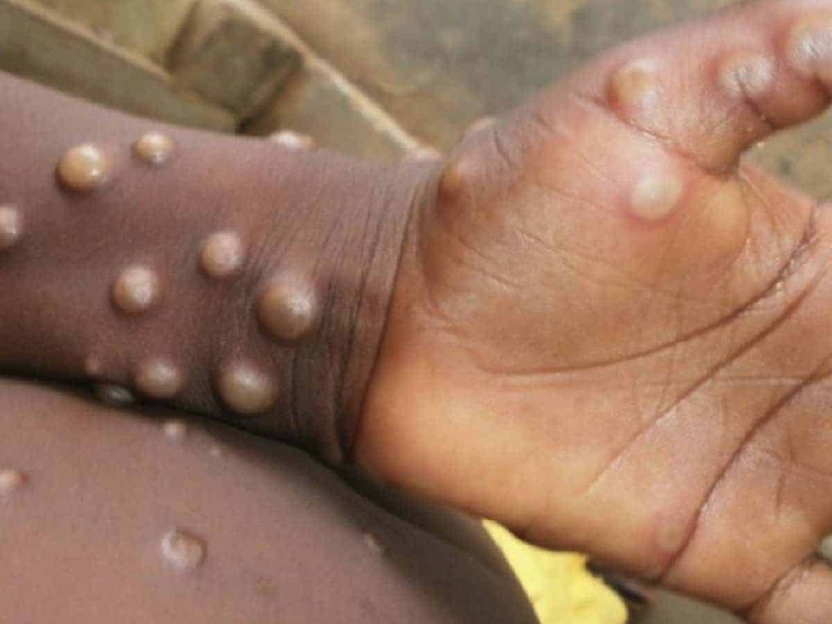 Karnataka:12-yr-old develops monkey pox symptoms