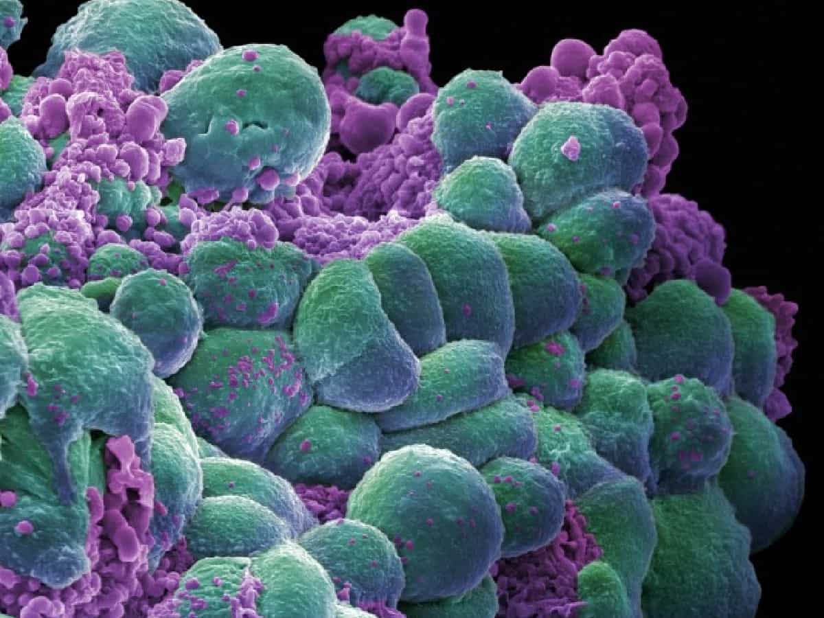 Removing extra chromosomes from cancer cells can prevents tumor growth: Study