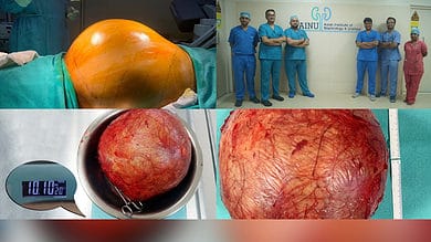 Doctors at Hyderabad hospital remove football-sized kidney tumour