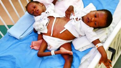 Saudi Arabia: 16-hr-surgery to separate conjoined Tanzanian twins begins