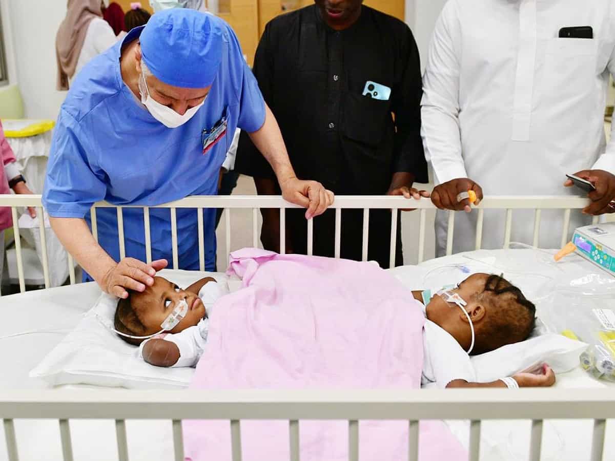 Saudi Arabia begins 14-hr surgery to separate Nigerian conjoined twins