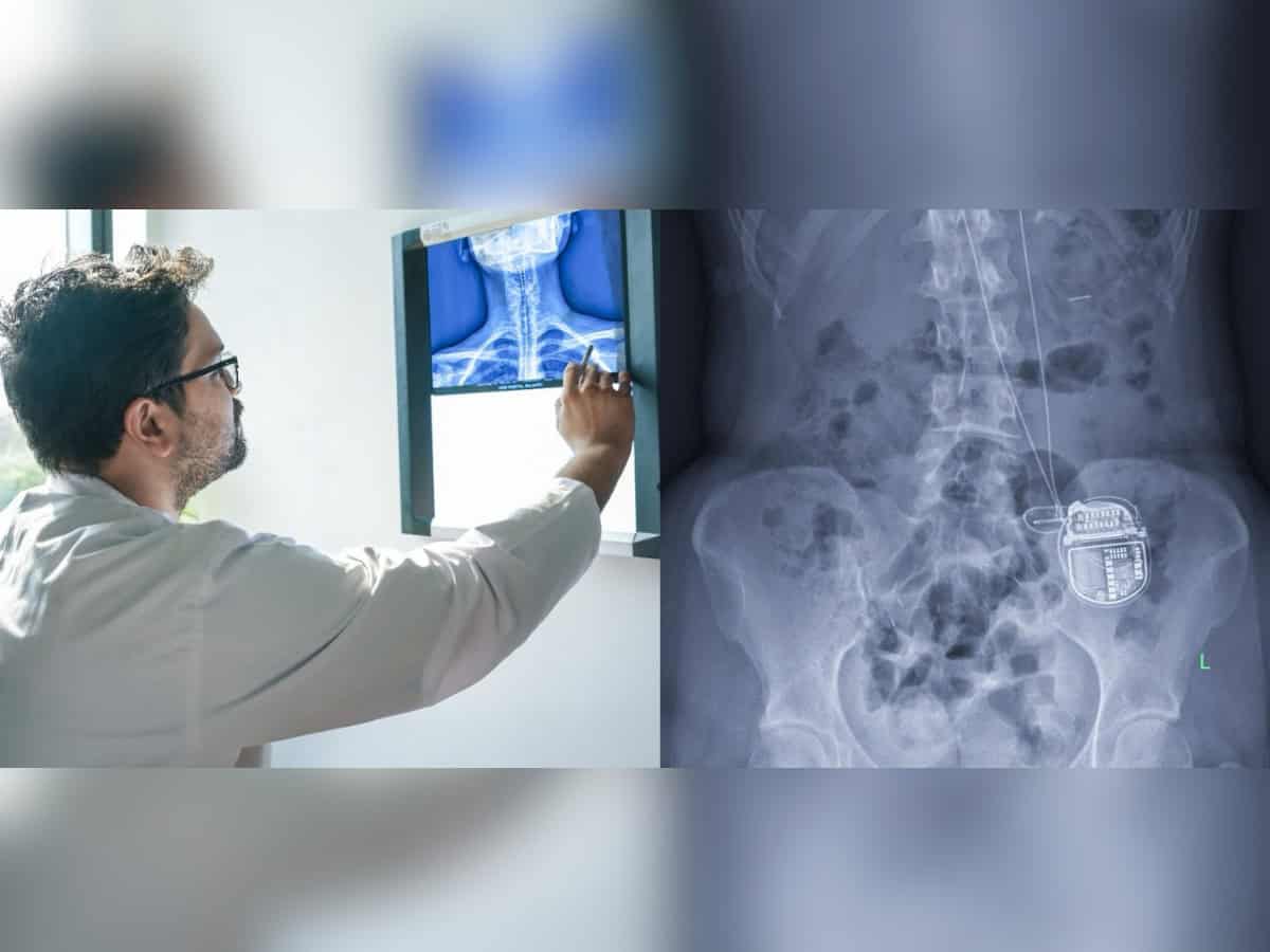 Hyderabad: AIG conducts Asia's 1st high cervical spinal cord stimulator implantation