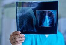 Medical professional examining lung X-ray for signs of lung cancer.